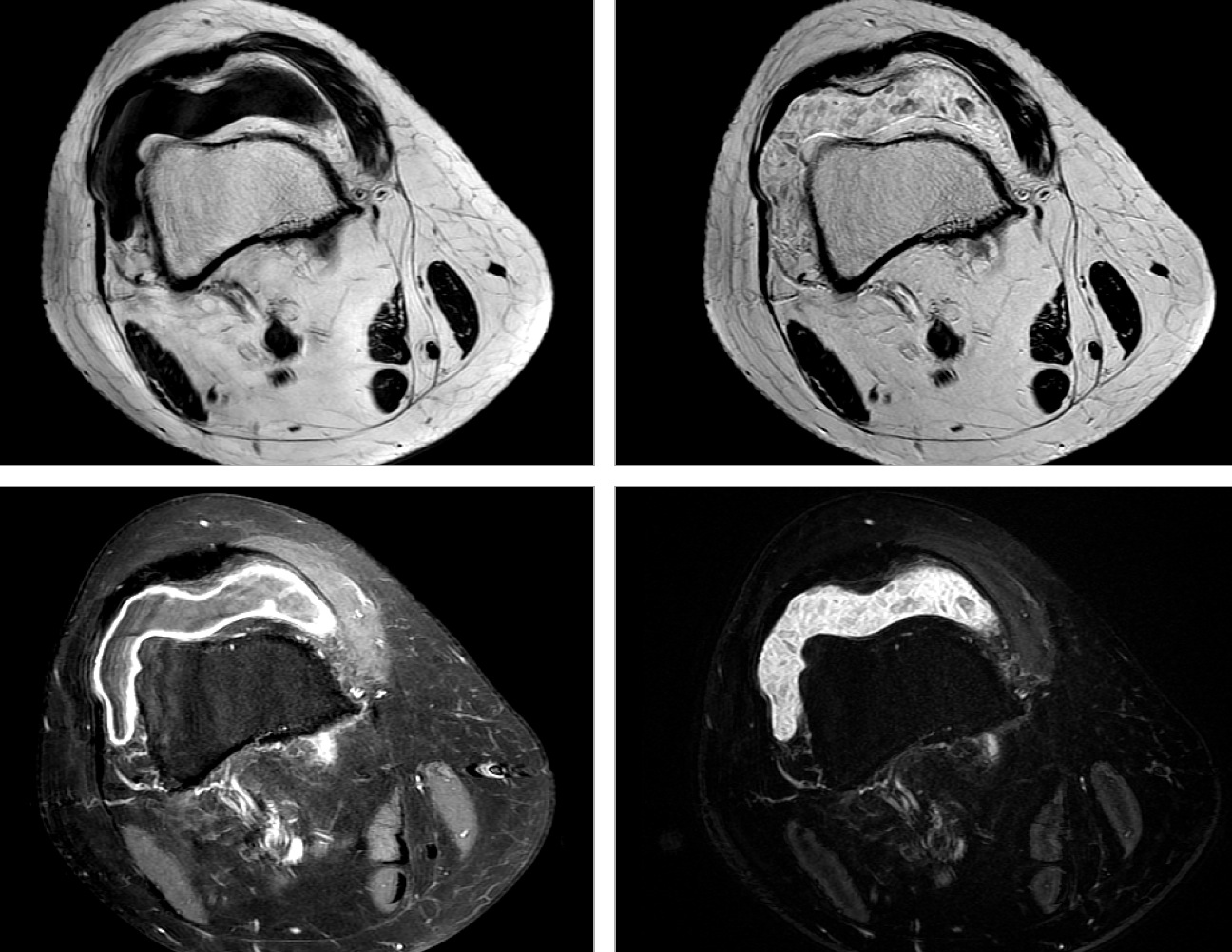 Figure 3 for case chronic synovitis